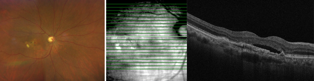 망막하출혈, 망막하액이 동반된 황반변성 치료 전