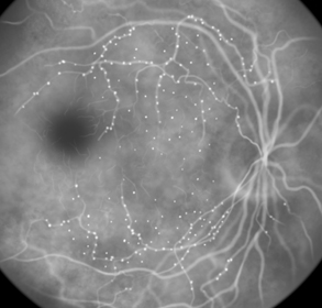 인도시아닌그린혈관조영