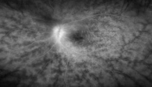 망막 모세혈관에서 조영제가 누출되는 모습