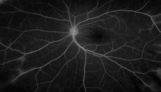 망막 모세혈관에서 조영제 누출이 현저히 줄어든 모습