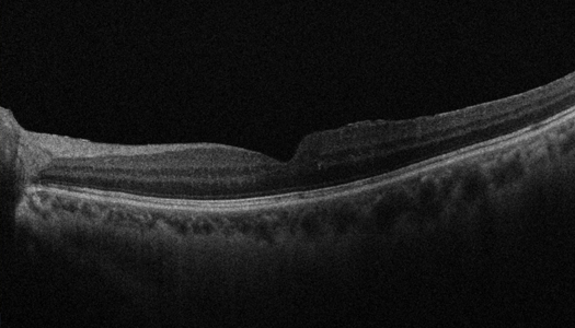 망막 정맥이 폐쇄되어 유리체강내 주사 치료를 받고 호전된 환자